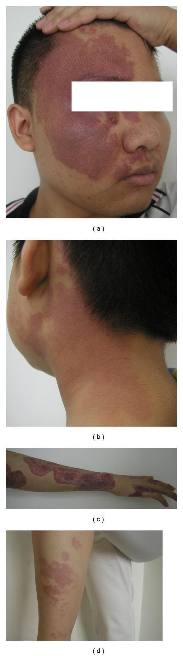 This set of clinical photographs illustrates the varied presentation of Port-Wine Stains (PWS), a congenital vascular malformation of the dermal capillaries. Image (a) depicts a large, confluent, reddish-purple macule on the face, following a distribution that involves the ophthalmic (V1) and maxillary (V2) branches of the trigeminal nerve. Small nodular elevations within the patch suggest early soft tissue or vascular hypertrophy. Image (b) shows smaller, lighter-colored erythematous patches on the neck with less defined borders. Images (c) and (d) demonstrate PWS on the extremities; the arm and hand show dark, irregularly shaped, and partially interconnected plaques, while the leg displays more discrete, scattered patches. The lesions are non-blanching and represent classic dermatological manifestations of capillary malformations, which may be isolated or associated with systemic syndromes like Sturge-Weber. These images serve as educational references for identifying lesion morphology, color intensity, and anatomical distribution across different body regions.