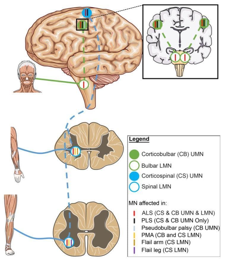 A medical schematic diagram illustrating the neuroanatomical pathways of upper motor neurons (UMN) and lower motor neurons (LMN) and their selective involvement in Amyotrophic Lateral Sclerosis (ALS) variants. The diagram features a lateral view of the human brain, a coronal section of the brain, and transverse sections of the spinal cord (cervical and lumbar levels). Two primary tracts are highlighted: the corticobulbar (CB) tract, represented by green solid circles (UMN) and open circles (LMN), and the corticospinal (CS) tract, represented by blue solid circles (UMN) and open circles (LMN). Solid circles represent UMN cell bodies in the motor cortex, while open circles denote LMNs in the brainstem (bulbar) and spinal cord. Colored vertical tick marks inside these circles indicate specific disease phenotypes: red for classic ALS (CS & CB UMN and LMN), black for Primary Lateral Sclerosis (PLS, UMN only), and yellow for Progressive Muscular Atrophy (PMA, LMN only). Other variants shown include Pseudobulbar palsy (CB UMN), Flail arm, and Flail leg (specific CS LMN segments). This illustration serves as an educational tool for differentiating motor neuron disease phenotypes based on the anatomical site of degeneration.