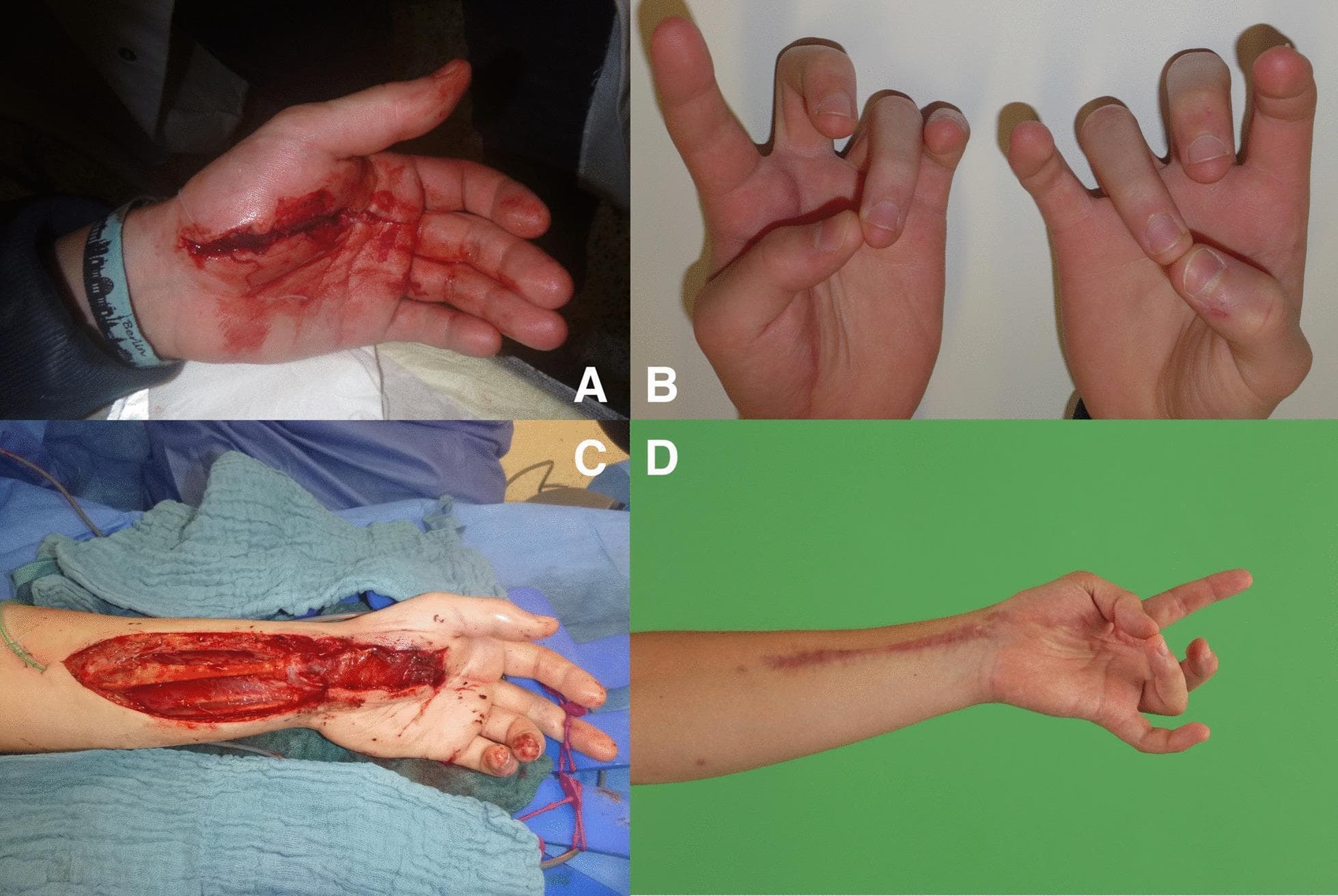 This four-part series of clinical photographs documents the management of a traumatic hand injury resulting in the loss of thumb opposition. Image A shows an acute, deep laceration across the thenar eminence with active bleeding, indicating damage to the thenar branch of the median nerve. Image B demonstrates the clinical consequence after initial wound closure: a significant deficit in thumb opposition (ape hand deformity), where the patient cannot touch the thumb tip to the small finger. Image C is an intraoperative view showing a functional free pronator quadratus (FFPQ) muscle transfer. A single long incision extends from the palm to the distal forearm, exposing the donor pronator quadratus muscle and the recipient thenar site for neurovascular anastomosis. Image D shows the 6-month postoperative result, displaying a healed linear surgical scar and restored functional thumb opposition. This series illustrates the surgical reconstruction of thenar muscle function using a local muscle flap to restore essential hand grip and pinch mechanics.