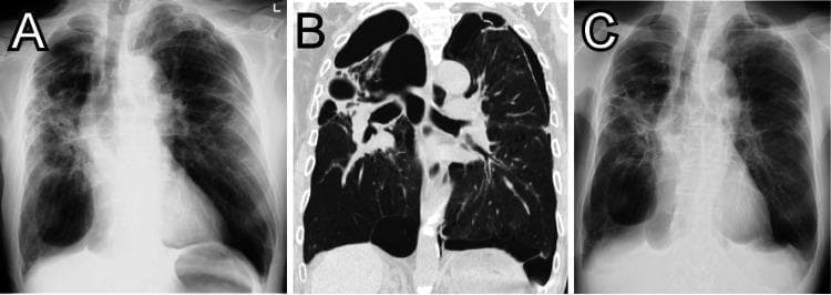 This composite figure demonstrates diagnostic imaging findings of bullous lung disease and pneumothorax in a patient with COPD. Image A is a frontal chest X-ray on presentation showing multiple large, thin-walled, hyperlucent areas consistent with giant bullae, particularly prominent in the lower zones, and a concomitant mild left-sided pneumothorax identified by a peripheral lucency and lack of lung markings. Image B is a coronal reformatted CT scan of the chest, providing high-resolution visualization of the lung parenchyma. It reveals extensive emphysematous changes and multiple, well-defined, thin-walled air-filled bullae of varying sizes occupying significant portions of both hemithoraces, with clear demarcation between the bullae and remaining compressed lung tissue. Image C is a follow-up chest X-ray taken 10 days later, showing stable appearance of the giant bullae but interval improvement and resolution of the previously seen left-sided pneumothorax, with better expansion of the underlying lung. The series highlights the importance of distinguishing between giant bullae and pneumothorax in patients with advanced obstructive lung disease.