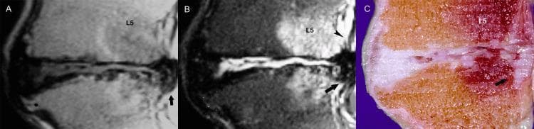 This composite figure presents a comparison of L5-S1 lumbar disc herniation across three modalities: (A) Sagittal T1-weighted MR, (B) Sagittal T2-weighted MR, and (C) an anatomical gross section. Image A shows advanced intervertebral osteochondrosis characterized by severe disc space narrowing, irregular vertebral end-plate configuration, and a prominent anterior osteophyte at the S1 level (asterisk). A posterior disc herniation is indicated by an arrow. Image B highlights the herniated segment (arrow), which demonstrates high signal intensity on T2-weighted imaging and appears to penetrate or disrupt the thin, dark line representing the posterior longitudinal ligament (arrowhead). The anatomical section in Image C provides pathological correlation, showing the structural degradation of the nucleus pulposus and the physical extrusion of disc material (arrow) into the spinal canal. This sequence illustrates the radiological-pathological correlation of degenerative disc disease and acute disc displacement in the lower lumbar spine.