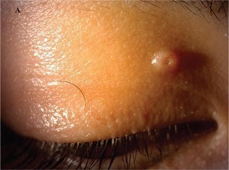 This clinical photograph shows a close-up of the right upper eyelid, depicting a classic presentation of Molluscum Contagiosum. The primary finding is a single, discrete, flesh-colored papule approximately 2x2 mm in size, located on the medial aspect of the eyelid near the lash line. The lesion exhibits a characteristic dome-shaped morphology with a distinct central pit or umbilication. The surface of the papule appears smooth and slightly waxy or shiny. The surrounding eyelid skin shows normal texture with subtle fine wrinkling and no significant surrounding erythema or edema in this view. This visual is an educational example used in ophthalmology and dermatology to illustrate a common viral skin infection that can cause secondary chronic follicular conjunctivitis if the lesion sheds viral particles into the tear film. The clinical significance lies in the recognition of the umbilicated center as a pathognomonic feature of the Poxvirus infection.