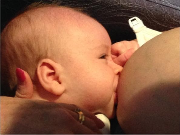 A clinical photograph depicting an 8-week-old infant breastfeeding, labeled as a 'pre-gestalt intervention' state. The image illustrates the physical dynamics of infant latching and maternal positioning. The infant is shown in a lateral profile with a relatively shallow latch; the mouth is open but primarily encompasses the nipple and only a minimal portion of the areola. The infant's chin is pressed against the breast tissue, while the nose remains close to the breast surface but clear for respiration. There is visible drawing of the breast tissue into the oral cavity. The mother's breast appears full, and her hand is visible supporting the infant's neck/head. A breastfeeding bra with a white plastic clasp is visible in the background. This clinical image is used in a medical educational context to demonstrate latch characteristics associated with maternal nipple pain and difficult attachment prior to corrective lactation support or positional interventions.