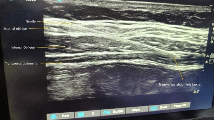 This diagnostic ultrasound image demonstrates the layered anatomy of the lateral abdominal wall, utilized for an ultrasound-guided transversus abdominis plane (TAP) block. The image clearly identifies three distinct muscle layers from superficial to deep: the external oblique, internal oblique, and transversus abdominis muscles. Each muscle layer appears as a relatively hypoechoic band separated by thin, bright hyperechoic fascial planes. A hyperechoic, linear needle is visualized using an 'in-plane' technique, traversing through the external and internal oblique muscles. The needle tip is positioned toward the fascial plane between the internal oblique and the transversus abdominis muscle, which is the target for local anesthetic deposition to block the thoracolumbar nerves (T7-L1). This imaging modality is essential in anesthesiology for providing regional analgesia following abdominal surgeries, ensuring accurate needle placement and reducing procedural complications.