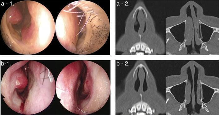 This composite medical image provides a comparative study of a patient before and three months after undergoing a modified cutting and suture technique (MCAST) to correct a deviated nasal septum.
Top Row (a-1, a-2): Preoperative findings. Panel a-1 shows clinical endoscopic photographs where a significant caudal septal deviation to the left side severely constricts the left nasal airway. Panel a-2 presents axial computed tomography (CT) scans confirming a sharp C-shaped septal curvature and substantial narrowing of the left nasal cavity compared to the patent right side.
Bottom Row (b-1, b-2): Postoperative findings. Panel b-1 displays endoscopic images following surgical correction, showing a straightened septum and significantly improved bilateral patency; visible sutures and mild mucosal erythema are noted. Panel b-2 contains postoperative axial CT scans demonstrating a midline septal position, symmetric enlargement of the nasal passages, and successful correction of the previous caudal deviation.
This material serves as an educational resource for otolaryngology and plastic surgery, illustrating the efficacy of septoplasty techniques in restoring nasal symmetry and airflow.