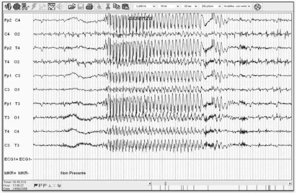 This diagnostic image is a multi-channel electroencephalogram (EEG) recording demonstrating an ictal event in a patient with Childhood Absence Epilepsy. The tracing displays a classic 3 Hz generalized spike-and-wave discharge pattern across multiple electrode pairs, including Fp2-C4, Fp1-C3, T4-C4, and C3-T3. The rhythmic discharge is characterized by high-amplitude, synchronous, and symmetrical complexes that emerge abruptly from the background. Before and after the paroxysmal activity, the background activity shows lower amplitude, less regular fluctuations indicative of interictal baseline states. The EEG montage includes an annotation 'assenza' (absence), marking the clinical correlation of the seizure activity. This recording is clinically significant for evaluating the efficacy of Vagus Nerve Stimulation (VNS) therapy in drug-resistant epilepsy, illustrating the morphology, frequency, and duration of generalized paroxysms used to assess treatment response and seizure reduction.