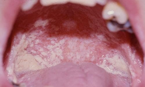 This clinical photograph shows a close-up intraoral view of a patient with extensive pseudomembranous oropharyngeal candidiasis (thrush). The oral cavity exhibits characteristic thick, white-to-creamy yellow plaques and curd-like patches distributed across the dorsal surface of the tongue, the hard and soft palates, and the buccal mucosa. The lesions consist of a mixture of small punctate spots and larger confluent patches with irregular, raised borders. Underneath and surrounding these white coatings, the mucosal tissue is markedly erythematous, indicating underlying inflammation. This presentation is highly characteristic of opportunistic fungal infection by Candida species, frequently seen in immunocompromised individuals, such as those with HIV/AIDS. The image demonstrates the hallmark clinical signs of oral thrush, which may be associated with symptoms like dysphagia and odynophagia if the infection extends into the esophagus.