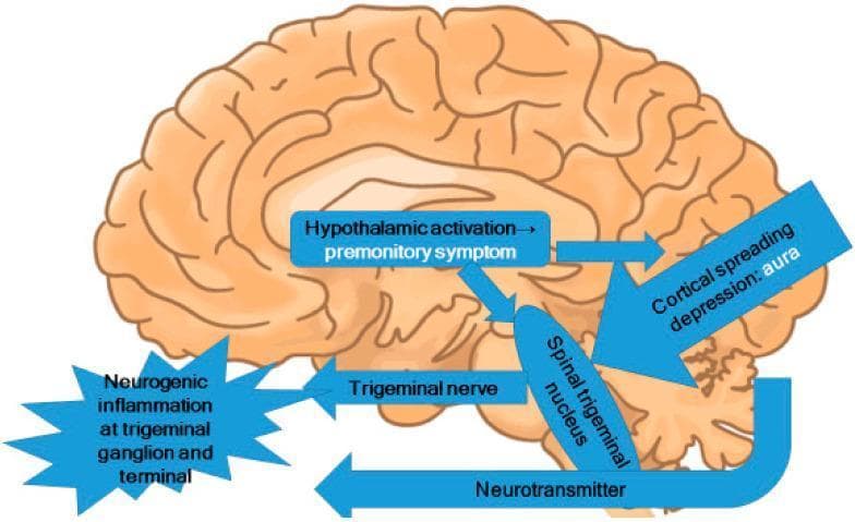 This pathophysiology diagram illustrates the central mechanisms of migraine, overlaid on a sagittal view of the human brain. The illustration highlights the interplay between several key neuroanatomical structures and processes. A central text box indicates 'Hypothalamic activation' leading to 'premonitory symptoms', with arrows showing its influence on the 'Spinal trigeminal nucleus' in the brainstem. Cortical spreading depression, associated with 'aura', is depicted as a large arrow targeting the same spinal trigeminal nucleus. The diagram outlines the involvement of the trigeminal nerve system, showing bidirectional activity: activation of the spinal trigeminal nucleus leads to 'Neurogenic inflammation at the trigeminal ganglion and terminal' (represented by a starburst graphic), while 'Neurotransmitter' release is shown signaling back from the brainstem to the peripheral trigeminal structures. This diagram serves as an educational tool for medical students and clinicians to understand the trigeminovascular system's role in migraine pathogenesis, specifically how hypothalamic and cortical triggers converge on the brainstem and peripheral nerve terminals.