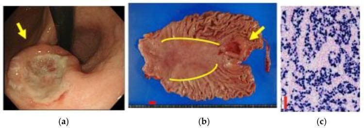 A multi-panel clinical and diagnostic figure demonstrating Epstein-Barr virus-associated gastric cancer (EBVaGC). Panel (a) is an endoscopic clinical photograph showing a gastric lesion near the cardia, characterized by a depressed morphology and a submucosal tumor (SMT)-like protrusion (marked by a yellow arrow). Panel (b) shows the macroscopic specimen from a total gastrectomy, displayed on a blue background with a 10 mm scale bar. The lesion (yellow arrow) is situated in the upper stomach near the gastric mucosal atrophic border, which is demarcated by yellow lines. Panel (c) is a histopathology image showing EBER-1 in situ hybridization (ISH). The image displays numerous tumor cell nuclei with positive dark purple staining, characteristic of carcinoma with lymphoid stroma (CLS) associated with EBV. The educational focus is on the endoscopic and macroscopic identification of EBVaGC, highlighting its typical location in the upper stomach and its distinctive histological signature.