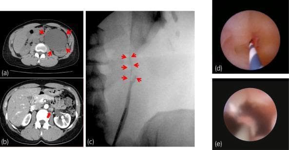 This composite figure illustrates the diagnosis and surgical outcome of ureteropelvic junction obstruction (UPJO) and subsequent stenosis. Panel (a) is an axial non-contrast CT scan showing severe left-sided hydronephrosis with a markedly dilated renal pelvis (red arrowheads). Panel (b) is a contrast-enhanced CT scan showing wall thickening at the UPJ and increased peri-ureteral fat stranding (red arrowhead), indicative of chronic inflammation or fibrosis. Panel (c) presents a retrograde pyelogram demonstrating a focal segment of anatomic ureteral stenosis (white arrowheads) where contrast flow is restricted. Panels (d) and (e) are ureteroscopic views. Image (d) shows the internal appearance of the high-grade ureteral stricture with a guide wire in place. Image (e) displays the same region following a redo pyeloplasty, showing a patent, widely open lumen with healthy-appearing mucosal lining, confirming successful surgical reconstruction and resolution of the obstruction.