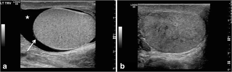 Two-panel gray-scale scrotal ultrasound images demonstrating sonographic features of testicular torsion in adolescent patients. Image (a) is a transverse view of the left scrotum showing a globular, enlarged testis with an abnormal horizontal lie (indicated by a white arrow). A surrounding anechoic area represents a reactive hydrocele (marked with a star). This orientation is characteristic of the 'bell clapper' deformity predisposing to torsion. Image (b) is a longitudinal view of a different patient's right testis showing a markedly heterogeneous parenchymal echotexture with mixed hyperechoic and hypoechoic areas. Such significant heterogeneity is a critical diagnostic sign of late-stage torsion, suggesting tissue congestion and potential nonviability. These diagnostic images illustrate key morphological and parenchymal changes used in pediatric radiology to differentiate testicular torsion from other causes of acute scrotum, such as epididymitis.