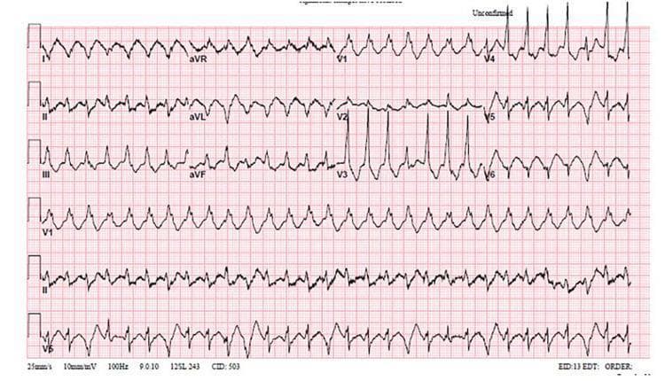 This diagnostic image is a 12-lead electrocardiogram (ECG) demonstrating a chaotic and highly irregular cardiac rhythm. The tracing is characterized by a lack of organized electrical activity, with no identifiable P waves, distinct QRS complexes, or T waves across most leads. The morphology varies significantly between leads, exhibiting both coarse and fine fibrillatory waves with inconsistent amplitudes and frequencies. In certain precordial leads, specifically V3 through V5, there are brief segments of rapid, wide-complex oscillations that suggest a transitional phase or a degenerating monomorphic ventricular tachycardia. However, the dominant finding is the asynchronous and disorganized electrical pattern pathognomonic for ventricular fibrillation. This ECG is a critical clinical finding in cardiovascular medicine, illustrating a life-threatening arrhythmia that requires immediate defibrillation. It serves as an educational tool for advanced cardiac life support (ACLS) training to distinguish organized ventricular tachycardia from the disorganized electrical state of ventricular fibrillation.