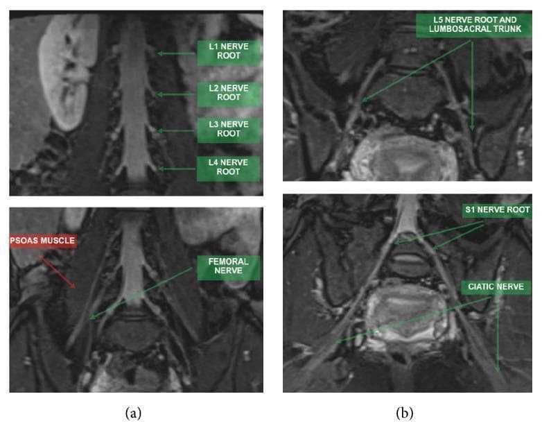 This diagnostic image consists of Magnetic Resonance Neurography (MRN) scans utilizing coronal STIR 3D SPACE (MIP) sequences to visualize the lumbosacral plexus.