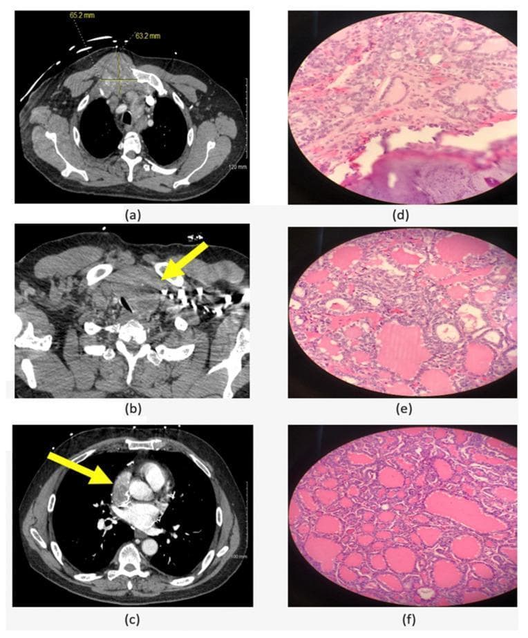 A multi-panel figure containing radiological and histopathological images of Follicular Variant of Papillary Thyroid Carcinoma (FVPTC) and its metastases. The left column displays axial CT scans: (a) shows a 6.5 cm soft tissue mass at the right manubrial costal junction with associated bone destruction; (b) illustrates a large left thyroid lobe mass causing significant tracheal compression and deviation; (c) demonstrates a 5.1 cm metastatic mass involving the superior vena cava and right atrium. The right column (d-f) presents H&E stained light microscopy images of resected tissues. Image (d) shows the chest wall metastasis, (e) shows the primary left thyroid tumor, and (f) shows the right atrial metastasis. All histological sections demonstrate characteristic features of FVPTC, including neoplastic follicular architecture with varying amounts of pink-stained colloid and cells with the nuclear features of papillary thyroid carcinoma. The composition illustrates the clinical progression and diagnostic findings of advanced differentiated thyroid cancer with rare cardiac and chest wall involvement.