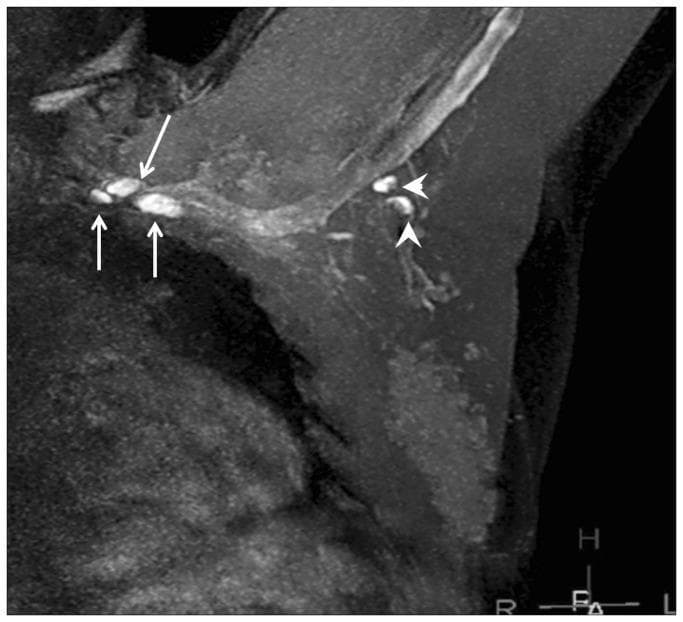 This diagnostic image is a Magnetic Resonance Lymphangiography (MRL) scan demonstrating the axillary lymphatic system in a breast cancer context. The grayscale image shows anatomical structures of the breast and axilla with gadolinium-based contrast enhancement highlighting the lymphatic pathway. Two distinct levels of axillary lymph nodes are identified by markers: Level 1 lymph nodes are indicated by arrowheads, appearing as bright, rounded hyperintense structures clustered in the lower axilla. Level 3 lymph nodes, indicated by arrows, are situated more superiorly and medially (infraclavicular region) and also exhibit high signal intensity, though they appear slightly smaller in this view. The image illustrates the use of MRL for visualizing nodal anatomy and mapping the lymphatic drainage pathway. High signal intensity (bright white) indicates successful contrast uptake, while the surrounding darker gray areas represent soft tissue and fat with lower signal intensity. This modality is used in oncology to assess lymph node morphology and potential metastatic involvement by identifying enhancement defects or vessel dilation.