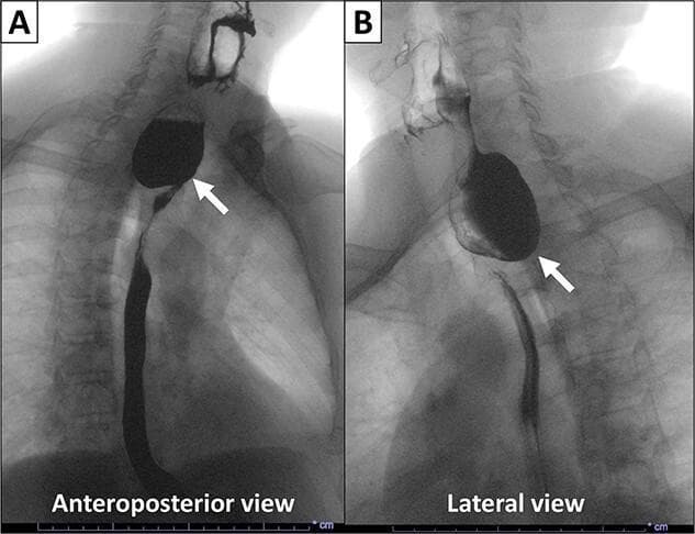 This diagnostic image is an X-ray esophagogram (barium swallow) showing a Zenker’s diverticulum in a human patient. The visual is divided into two panels: an Anteroposterior (AP) view (A) and a Lateral view (B). Both views demonstrate a large, contrast-filled, saccular outpouching measuring approximately 4 x 5 cm. In the AP view, the diverticulum appears as a prominent, rounded, radiopaque mass originating from the proximal esophagus. The Lateral view confirms the pathology is a pulsion diverticulum arising from the posterior aspect of the esophagus, specifically through Killian's triangle (the pharyngoesophageal junction). White arrows in both panels point to the relatively narrow neck of the diverticulum, measuring 1.7 cm in width. The contrast material (barium suspension) clearly opacifies the diverticular lumen and outlines the distal esophageal lumen, which appears narrowed due to the mass effect of the filled sac. Key educational concepts include the diagnosis of upper esophageal dysphagia and the typical posterior location of pharyngoesophageal diverticula.