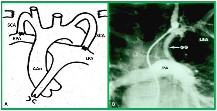 This dual-panel image illustrates surgical approaches for augmenting pulmonary blood flow in cyanotic heart disease. Panel A is a historical anatomical diagram showing the classic Blalock-Taussig shunt, depicting the end-to-side anastomosis of the subclavian arteries (SCA) to the right (RPA) and left (LPA) pulmonary arteries, respectively, branching from the ascending aorta (AAo). Panel B is a clinical diagnostic image consisting of a selective cine-angiogram frame demonstrating a modified Blalock-Taussig (mBT) shunt. It shows a tubular, radio-opaque Gore-Tex graft (GG) originating from the region of the left subclavian artery (LSA) and connecting inferiorly to a widely patent pulmonary artery (PA). This comparison highlights the evolution from direct arterial anastomosis to the use of synthetic interposition grafts to increase pulmonary perfusion. The material is relevant for pediatric cardiology and cardiothoracic surgery education regarding palliative procedures for complex congenital heart defects.