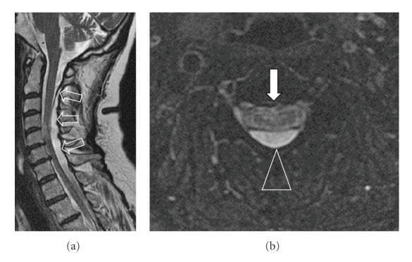This diagnostic image consists of two MRI views of the cervical spine illustrating a dorsal intradural-extramedullary cystic lesion. (a) A sagittal T2-weighted MRI demonstrates a large, hyperintense cystic cavity extending from the cervicocranial junction to the level of the T4 vertebral body. Open arrows highlight the dorsal location of the cyst, which causes significant anterior displacement of the cervical spinal cord (myelon). Intramedullary hyperintensities, consistent with myelopathy, are visible at the C4/5 and C6/7 levels. (b) An axial T2*-weighted image at the cervical level shows the relationship between the hyperintense mass and the neural structures. A triangle marker points to a distinct thick membrane separating the cystic lesion from the spinal cord, while a filled arrow indicates intrinsic myelopathy signal changes within the cord parenchyma. This case illustrates the radiological features of a spinal arachnoid cyst and its secondary effects on the spinal cord, useful for neurology and neurosurgery education.