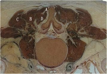 This anatomical diagram presents an axial cross-section of the upper lumbar spine, focusing on the organization and relationships of the posterior paraspinal musculature. The image demonstrates the components of the erector spinae group and the deeper intrinsic back muscles relative to bony landmarks such as the spinous process and vertebral body. Labels indicate the following structures: (A) Spinalis muscle, the most medial component of the erector spinae, located adjacent to the spinous process; (B) Longissimus muscle, situated laterally to the spinalis; (C) Iliocostalis muscle, representing the most lateral column of the erector spinae group; and (D) Multifidi muscles, which are positioned deep to the erector spinae and immediately lateral to the vertebral laminae and spinous process. This anatomical mapping is critical for understanding the surgical corridors used in paraspinal approaches, such as direct spinal canal decompression or pedicle screw fixation in the treatment of lumbar burst fractures. The cross-section clearly delineates the fascial planes separating these muscle groups, providing essential guidance for minimally invasive surgical retraction.