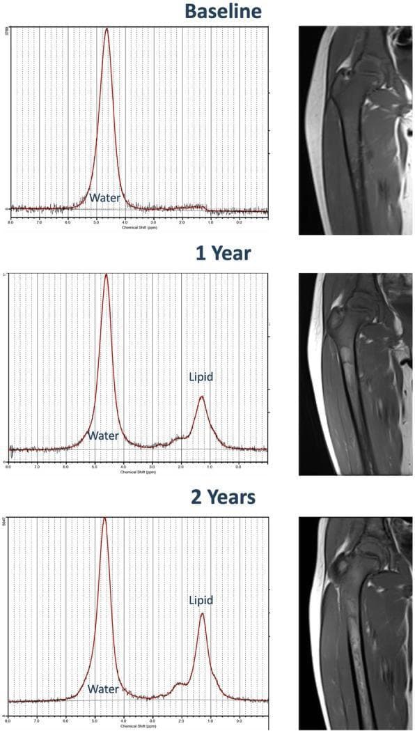 This composite educational image illustrates the longitudinal response of bone marrow to enzyme replacement therapy (ERT) in a pediatric patient with Gaucher disease over a two-year period. The panel is organized into three time points: Baseline, 1 Year, and 2 Years. The left column displays Magnetic Resonance Spectroscopy (MRS) spectra, which quantitatively track the marrow's chemical composition. At Baseline, a single dominant water peak is visible with a negligible lipid peak, representing high cellular infiltration. By 1 Year and 2 Years, a progressive increase in the 'Lipid' peak (fat fraction) is observed relative to the 'Water' peak, indicating therapeutic replacement of Gaucher cells with normal yellow marrow. The right column contains corresponding T1-weighted coronal MRI scans of the right proximal femur. These clinical images show a transition from diffuse, low-signal marrow infiltration at Baseline to a subtle but progressive increase in T1 signal intensity by Year 2. This brightening of the medullary canal correlates with the increasing fat fraction identified on MRS, serving as a visual marker for improved marrow health and treatment efficacy.