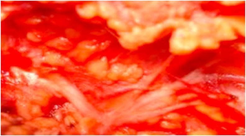 This intraoperative clinical photograph displays an anatomical dissection of the facial nerve (Cranial Nerve VII) within the parotid region. The image illustrates a 'Type II' branching pattern characterized by a single facial nerve trunk (FNT) that divides directly into multiple terminal branches. Notably, this variant lacks the typical primary bifurcation into temporofacial and cervicofacial divisions. The nerve branches appear as thin, pale, string-like structures radiating through the reddish, fleshy tissue of the surgical field. The surrounding area shows exposed glandular and soft tissue relevant to a parotidectomy procedure. This visual serves as an educational reference for surgical anatomy, highlighting normal anatomical variations of the extracranial facial nerve that are critical for surgeons to identify during parotid gland surgery to avoid nerve injury and post-operative facial paralysis.