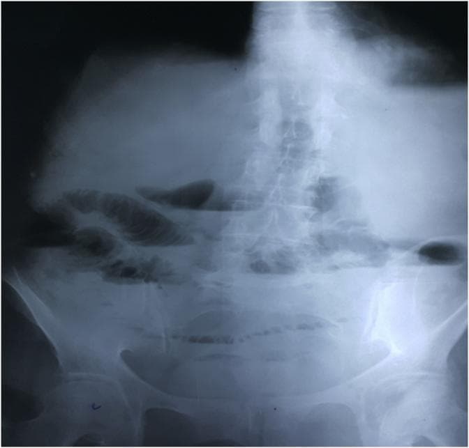 This diagnostic image is a plain erect abdominal X-ray (radiography) demonstrating classic radiographic features of an intestinal obstruction. The most prominent finding is the presence of multiple dilated loops of small bowel containing horizontal air-fluid levels, concentrated in the central and upper abdominal regions. The dilated loops exhibit visible valvulae conniventes (plicae circulares), which are thin mucosal folds that span the entire diameter of the bowel lumen, identifying these as small intestinal loops. A significant clinical sign is the complete absence of gas within the large bowel and rectum, indicating a high-grade or complete mechanical obstruction proximal to the colon. The lumbar spine and pelvic bones are visible, providing anatomical context for the bowel loop distribution. This image is a primary educational resource for recognizing the 'step-ladder' pattern of small bowel obstruction and differentiating small bowel from large bowel dilation in an acute clinical setting.