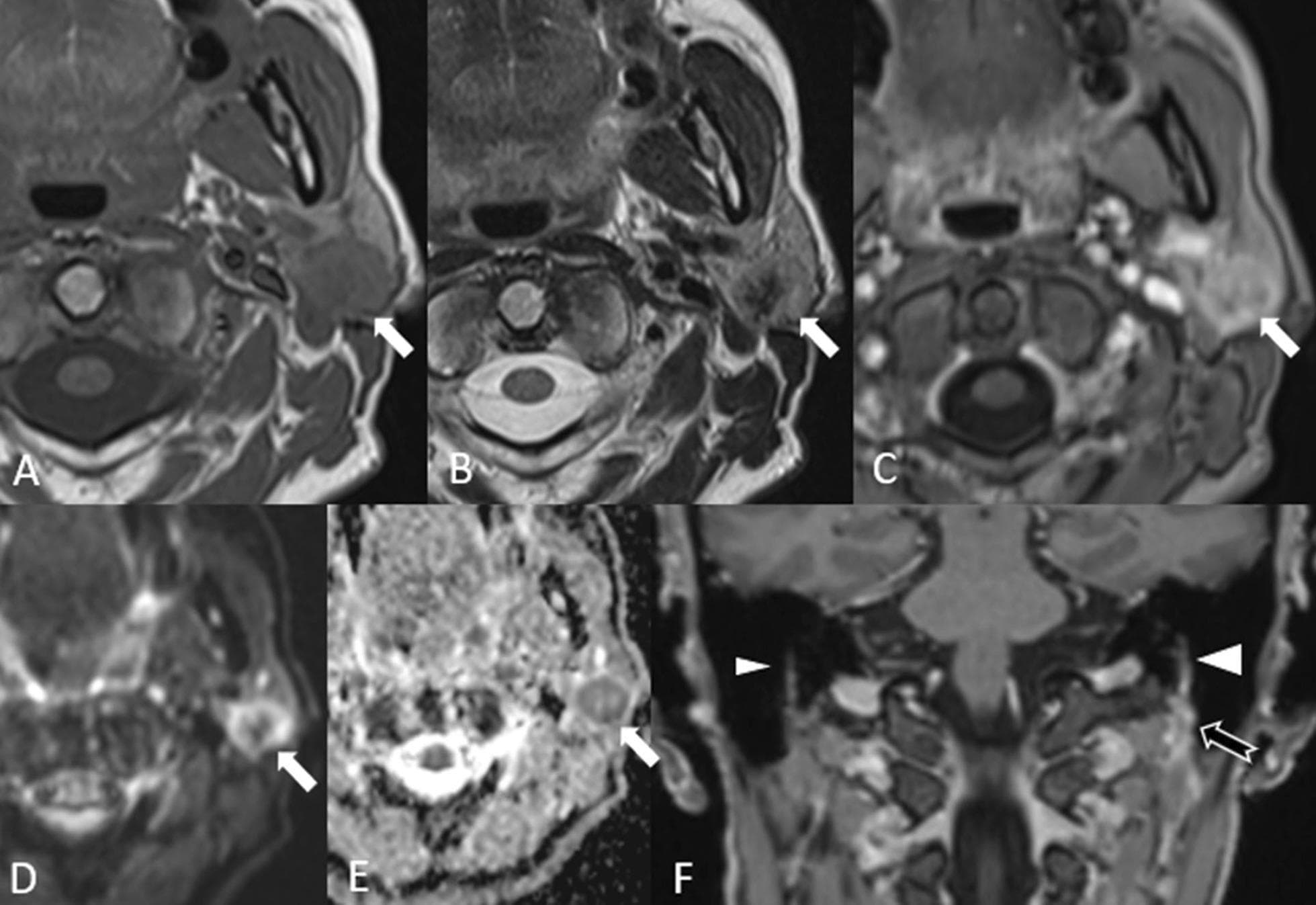 This composite of six diagnostic magnetic resonance (MR) images demonstrates high-grade parotid carcinoma with perineural tumor spread in a 63-year-old patient. (A) Axial T1-weighted image shows a lobulated, hypointense mass in the left parotid gland. (B) Axial T2-weighted image reveals the lesion with central hypointensity. (C) Post-contrast axial T1-weighted image demonstrates heterogeneous enhancement of the primary tumor. (D, E) Diffusion-weighted imaging (DWI) and the corresponding apparent diffusion coefficient (ADC) map show restricted diffusion at the tumor periphery, suggesting high cellularity. (F) Coronal 3D Multi-Planar Reconstruction (MPR) after contrast administration highlights asymmetrical thickening and pathological enhancement of the left facial nerve (indicated by a large arrowhead) compared to the normal right side (small arrowhead). Additionally, there is abnormal enhancing tissue around the left stylomastoid fossa. The visual findings correlate with the clinical presentation of facial paralysis, emphasizing the role of MRI in evaluating malignant invasion and perineural extension in salivary gland oncology.