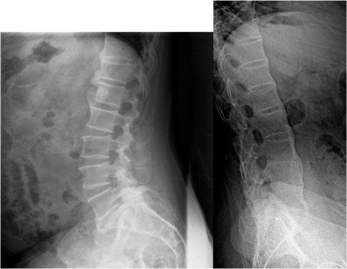 This side-by-side comparison chart consists of two lateral X-ray radiographs of the lumbar spine, demonstrating different patterns of syndesmophyte formation in axial spondyloarthritis. Image A shows Psoriatic Arthritis with axial involvement, characterized by coarse, 'chunky', and asymmetric syndesmophytes. These bony outgrowths appear irregular and do not uniformly bridge the vertebral segments. Image B demonstrates a classic 'bamboo spine' appearance typical of advanced Ankylosing Spondylitis. This is characterized by thin, symmetric, and marginal syndesmophytes that create a continuous vertical bridge of ossification between the vertebral bodies, leading to complete spinal fusion and a rigid, straightened alignment. The educational focus is on the diagnostic differentiation between the irregular, non-marginal ossification of psoriatic spondylitis and the uniform, marginal ossification of axial spondyloarthritis. These visual signs are critical for clinicians in rheumatology and radiology for identifying specific seronegative spondyloarthropathies.