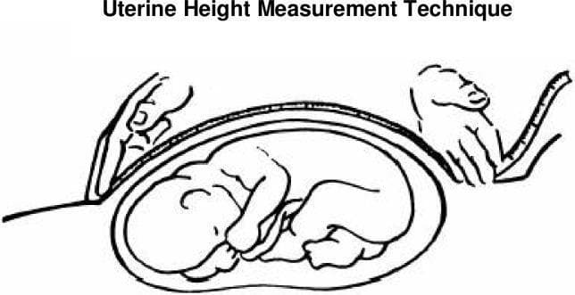 This medical illustration demonstrates the standardized technique for measuring symphysis-fundal height (SFH) during pregnancy. The diagram shows a sagittal-style cross-section of a gravid uterus containing a fetus in a cephalic presentation. A flexible, non-stretchable measuring tape is used to quantify the uterine height. One hand of the clinician is shown anchoring the 'zero' mark of the tape at the upper border of the symphysis pubis. The second hand is positioned at the uterine fundus, the highest point of the uterus, ensuring the tape follows the longitudinal curve of the abdominal wall. This clinical measurement is a primary screening tool in obstetrics used to monitor fetal growth, estimate gestational age, and screen for conditions such as intrauterine growth restriction (IUGR) or macrosomia. The visual emphasizes the proper placement of hands and the orientation of the measurement tool relative to maternal anatomical landmarks and the internal fetal position.