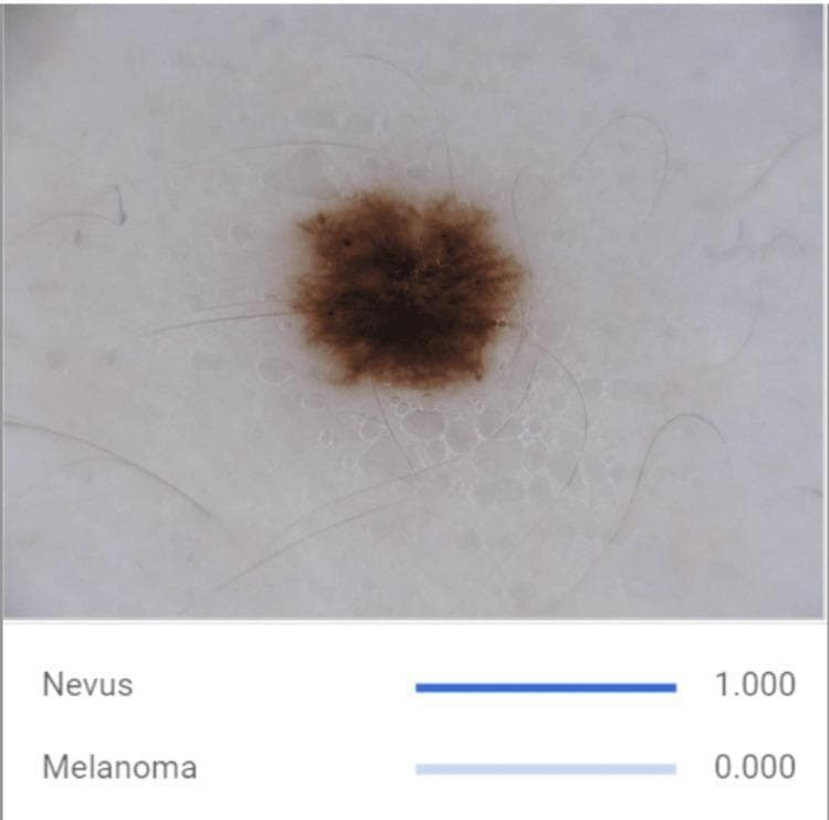 This clinical photograph displays a dermatoscopic-style view of a benign melanocytic nevus, accompanied by artificial intelligence (AI) classification data. The primary lesion is a centrally located, pigmentary skin lesion characterized by relatively regular and well-demarcated borders, a symmetrical oval shape, and a predominantly uniform brown coloration. Fine, light-colored terminal hairs are seen crossing over the lesion surface. The surrounding skin exhibits a faint, net-like pigment pattern. Below the clinical image, an educational graphical interface shows the output of a convolutional neural network (CNN) model, providing a classification score of 1.000 for 'Nevus' and 0.000 for 'Melanoma'. This visual demonstrates the distinguishing morphological features of benign nevi—symmetry, border regularity, and color uniformity—used in clinical dermatology and computer-aided diagnostic systems to differentiate them from malignant melanoma.