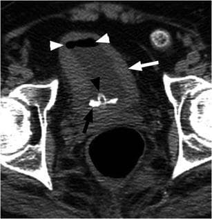 This axial non-contrast computerized tomography (CT) image of the pelvis demonstrates a neurogenic bladder in a patient with a spinal cord injury. Key visual findings include significant circumferential thickening of the urinary bladder wall (white arrow), characteristic of chronic bladder outlet obstruction or neurogenic dysfunction. Within the bladder lumen, a high-attenuation, calcified bladder stone is visible layering dependently (black arrow). An indwelling urinary catheter is present, identified by the catheter tubing and balloon (black arrowhead). Small pockets of gas are also noted within the superior aspect of the bladder lumen (white arrowheads), which can be secondary to instrumentation from the catheter or indicative of infection by gas-forming organisms. The image serves as a clinical example of the secondary complications of neurogenic bladder, including urolithiasis and chronic cystitis, frequently encountered in patients requiring long-term urinary catheterization.