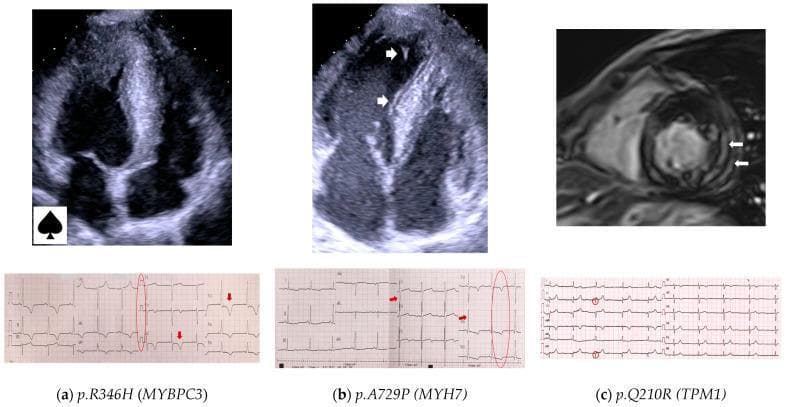 This composite figure presents clinical imaging and electrocardiogram (ECG) data for Hypertrophic Cardiomyopathy (HCM) associated with specific genetic variants.