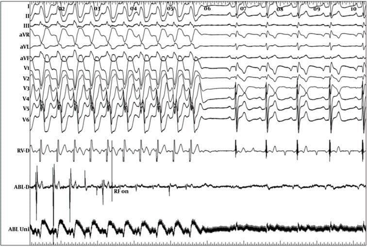 An intracardiac electrogram (EGM) and surface 12-lead electrocardiogram (ECG) recording demonstrating the termination of monomorphic ventricular tachycardia (VT) during an electrophysiology study (EPS). The upper section displays surface leads I, II, III, aVR, aVL, aVF, and V1-V6, showing a wide-complex tachycardia with a left bundle branch block (LBBB) morphology and inferior axis. The lower section includes intracardiac signals from the right ventricle (RV-D) and ablation catheter (ABL-D, ABL Uni). At time point 05, the label 'RF on' indicates the initiation of radiofrequency energy application. Following this intervention, there is a clear transition from the rapid VT rhythm to a slower, more organized rhythm (likely sinus rhythm or a paced rhythm), visible as the widening and subsequent narrowing of QRS complexes on the surface ECG and the stabilization of EGM signals. This visual represents a successful catheter ablation procedure in a patient with suspected Brugada syndrome or arrhythmogenic substrate in the right ventricular outflow tract (RVOT).