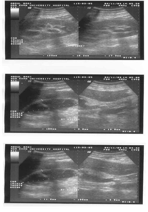 This set of three ultrasound images demonstrates bilateral renal pathology in a 65-year-old male. The top panel shows the left kidney with evidence of hydronephrosis, characterized by an anechoic dilation of the renal pelvis, and an echogenic renal stone. The middle and bottom panels visualize the right kidney, which appears smaller and more echogenic, consistent with chronic scarring. A pigtail percutaneous nephrostomy catheter is visible within the renal collection system as a bright, linear echogenic structure. In the lower panel, a hyperechoic focus with distal acoustic shadowing is identified in the proximal ureter, signifying an obstructive ureteric stone. These diagnostic images illustrate key features of obstructive uropathy, including hydronephrosis, nephrolithiasis, and the use of drainage catheters in the management of renal obstruction. The comparative views highlight the difference between acute obstructive changes in a preserved kidney (left) and chronic changes (scarring) in the contralateral kidney (right).