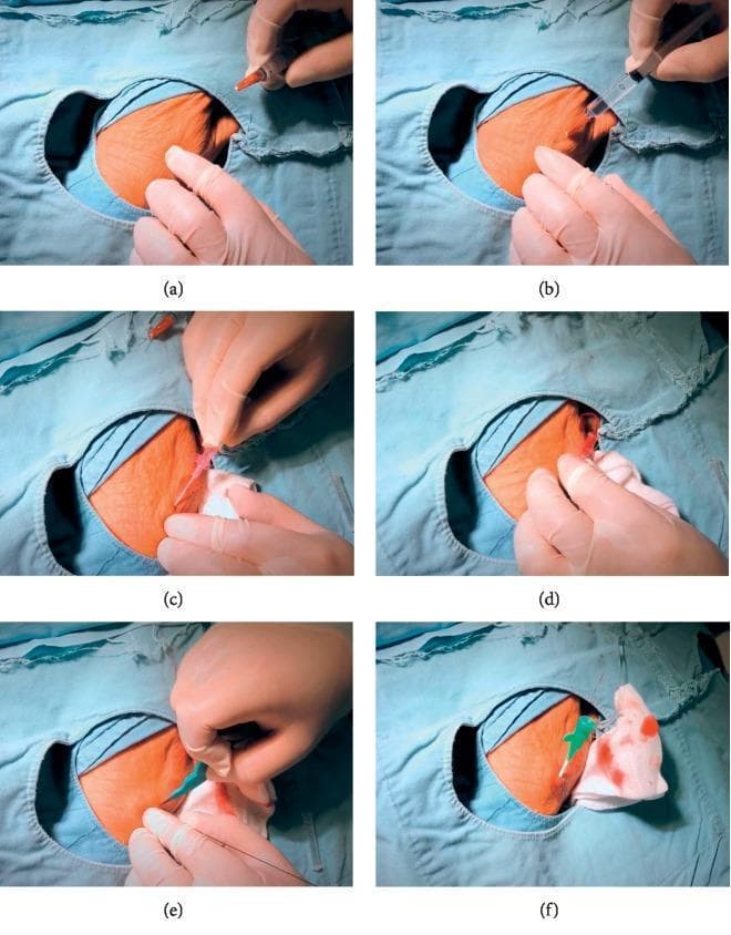 A series of six clinical photographs (a-f) documenting the step-by-step procedural technique for distal radial artery access in the first intermetacarpal space of the hand. (a) Identification and confirmation of the arterial pulse at the vertex between the long extensor tendon and the second metacarpal. (b) Administration of local anesthetic (lidocaine) using a fine-gauge syringe. (c) Arterial puncture using a micropuncture needle or cannula-over-needle at a shallow angle (<30 degrees), showing immediate blood return. (d) Successful stabilization of the needle following arterial entry. (e) Execution of a small skin incision with a surgical scalpel to facilitate the introduction of the vascular sheath over a guide wire, which is visible in the foreground. (f) Final placement of a 6 Fr introducer sheath in situ, secured with gauze for hemostasis. This sequence illustrates the distal radial access technique, commonly used in interventional cardiology and radiology to reduce vascular complications and improve patient comfort compared to traditional wrist access.