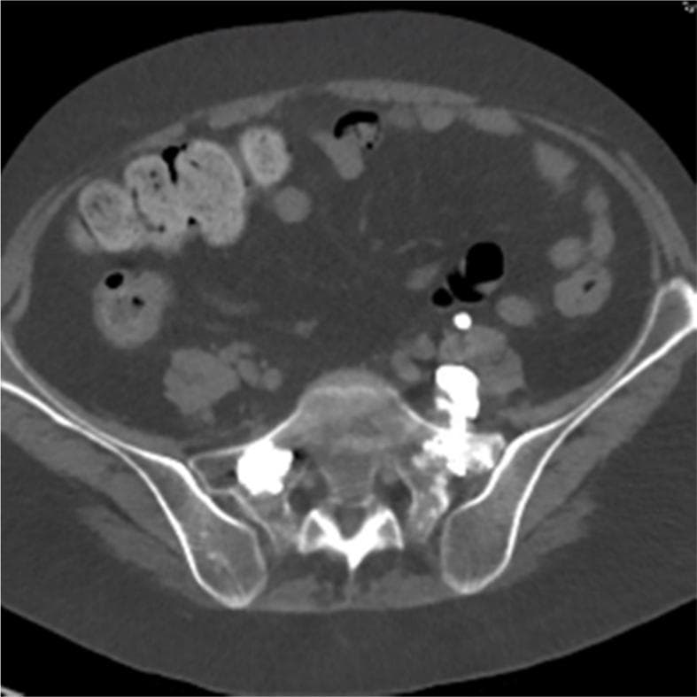 This diagnostic image is an axial computed tomography (CT) scan of the lumbosacral spine, performed without contrast. It demonstrates a common complication of percutaneous sacroplasty: cement extravasation. The high-density (radiopaque) polymethyl methacrylate (PMMA) cement is clearly visible bilaterally within the sacral ala. On the left side, there is significant extravasation of the cement material anterior to the left sacral ala. The leaked material appears as irregular, clustered hyperdense masses situated in the ventral epidural space and along the anatomical course of the left L5 nerve root. The extravasation is also in close proximity to the posterior aspect of the left iliopsoas muscle and deep to the iliac vasculature. Other visible structures include the vertebral body, bilateral iliac bones, and peripheral loops of bowel. This image serves as an educational example of iatrogenic cement leakage and its potential to cause radiculopathy or secondary inflammation of surrounding soft tissues following spinal augmentation procedures.