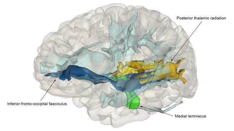 This diagnostic visualization features a 3D glass-brain model displaying white matter tracts reconstructed using diffusion MRI fiber tractography. The image highlights neuroanatomical structures within the translucent cortical shell to illustrate associations with polygenic scores for cognition. Three key tracts are color-coded based on nominal statistical significance: the inferior fronto-occipital fasciculus (IFOF) is shown in dark blue, extending horizontally from the frontal to the occipital pole; the medial lemniscus is highlighted in bright green at the level of the brainstem/pons; and the posterior thalamic radiation is depicted in yellow, branching through the posterior subcortical regions toward the visual cortex. Non-significant background tracts are rendered in a pale light-blue. This anatomical diagram serves to demonstrate the spatial distribution of white matter microstructural integrity and its correlation with genetic determinants of cognitive performance, providing a visual representation of how specific fiber pathways across different regions of the brain relate to genomic data in a population-based study.