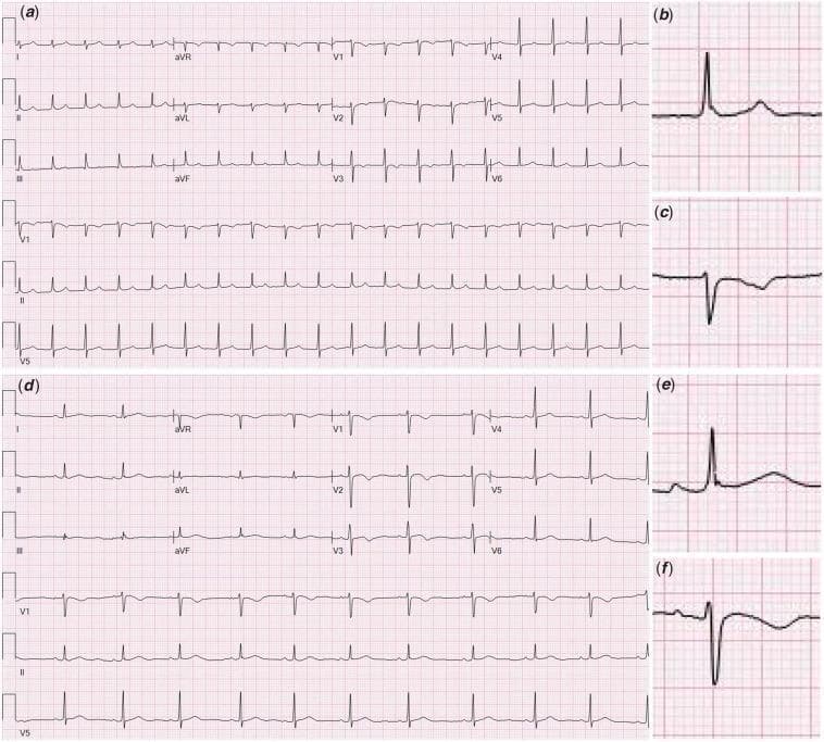 A multi-panel comparative electrocardiogram (ECG) demonstrating the diagnostic features of junctional tachycardia versus normal sinus rhythm. Panel (a) shows a 12-lead ECG of junctional tachycardia characterized by a rapid, narrow-complex rhythm with a rate exceeding 100 bpm and an absence of normal preceding P waves. Magnified inserts (b) and (c) highlight Lead II and V1 respectively, revealing retrograde (inverted) P waves occurring after the QRS complex, indicating atrial depolarization originating from the atrioventricular (AV) junction. Panel (d) displays a standard 12-lead ECG of normal sinus rhythm for comparison. Magnified inserts (e) and (f) for Lead II and V1 demonstrate normal morphology with upright P waves consistently preceding each QRS complex at a regular rate. This diagnostic image is intended for cardiology education to illustrate electrophysiological changes in junctional arrhythmias and the importance of P-wave morphology and timing in rhythm identification. This case is clinically relevant in the context of MIS-C and pediatric myocarditis where AV nodal inflammation may occur.