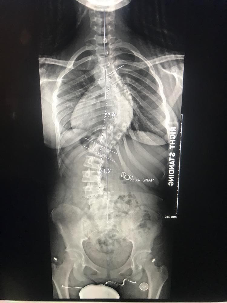This diagnostic image is a standing posteroanterior (PA) 36-inch full-spine radiograph demonstrating significant adolescent idiopathic scoliosis. The visual field extends from the cervical spine down to the pelvis and proximal femurs, allowing for a comprehensive assessment of coronal and spinopelvic alignment. The primary deformity consists of an S-shaped double curve: a right-convex thoracic curve with a measured Cobb angle of 57.0° and a left-convex lumbar curve with a measured Cobb angle of 41.3°. Measurement lines are visible along the superior and inferior end vertebrae for each curve. Anatomical landmarks include the rib cage, heart silhouette, and pelvic structures (iliac wings, sacrum, and femoral heads). Radiographic markers include a 'STANDING' orientation label and a vertical scale bar calibrated to 240 mm. This imaging modality is essential for preoperative planning in scoliosis surgery to evaluate the severity of the spinal curvature and the patient's global balance.