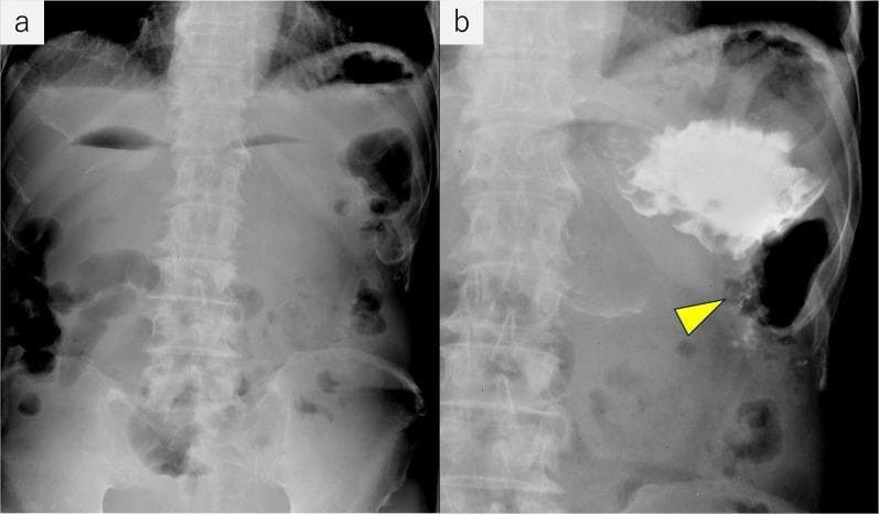 This dual-panel medical visual displays upper gastrointestinal fluoroscopy and abdominal radiography of a 60-year-old male with signs of high intestinal obstruction. Panel (a) is a plain abdominal radiograph showing multiple horizontal air-fluid levels (niveau formations) in the upper quadrant, corresponding to a dilated stomach, duodenum, and proximal jejunum. Panel (b) shows a contrast-enhanced fluoroscopic image following a gastrojejunostomy. A large volume of radiopaque contrast medium is retained within a significantly dilated stomach, indicating delayed gastric emptying. A yellow arrowhead points to a minimal trace of contrast passing into the efferent loop of the gastrojejunostomy, demonstrating a severe functional or mechanical stricture at the anastomosis site. The images illustrate gastric outlet-type obstruction secondary to external compression from metastatic renal cancer, highlighting the characteristic radiological signs of proximal bowel distension and impaired contrast transit in a postoperative setting.