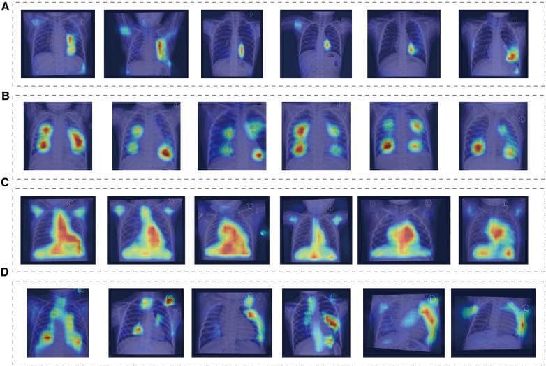 This diagnostic image displays a series of pediatric chest X-rays overlaid with Class Activation Mapping (CAM) heatmaps, used to visualize deep learning model attention in classifying congenital heart diseases. The figure is organized into four rows corresponding to specific diagnostic groups: (A) Normal, (B) Atrial Septal Defect (ASD), (C) Ventricular Septal Defect (VSD), and (D) Patent Ductus Arteriosus (PDA). In the Normal group, heatmap intensity is low and localized primarily near the cardiac silhouette or upper mediastinum. The ASD group shows moderate-intensity foci distributed across the bilateral lung fields, particularly in the hilar and upper lung regions. The VSD group exhibits the most intense and confluent heatmaps, heavily concentrated over the enlarged heart and central thoracic structures, reflecting cardiomegaly and increased pulmonary blood flow features. The PDA group displays a more scattered, diffuse pattern of moderate intensity along the pulmonary vasculature and cardiac borders. This visualization demonstrates how AI models prioritize different anatomical and pathological features, such as cardiac size and pulmonary vascular markings, to differentiate between shunting lesions in congenital heart disease.
