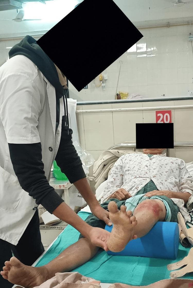 This clinical photograph depicts a post-traumatic physical therapy or rehabilitation session in a hospital setting. A patient is positioned supine on a medical bed, demonstrating a vastus medialis oblique (VMO) strengthening exercise. The right lower extremity is active, with the knee supported by a blue cylindrical foam bolster, facilitating terminal knee extension or isometric contraction. The right knee exhibits a large, erythematous, and abraded area consistent with recent skin trauma or friction injury. A clinician, wearing a white coat and stethoscope, provides tactile guidance and stabilization at the patient's ankle and foot. The anatomical focus is on the quadriceps mechanism and knee joint rehabilitation. This procedural image illustrates phase-wise rehabilitation following knee injuries, such as posterolateral corner (PLC) injuries or tibial plateau contusions, where restoring VMO strength is critical for patellofemoral stability and joint mechanics.