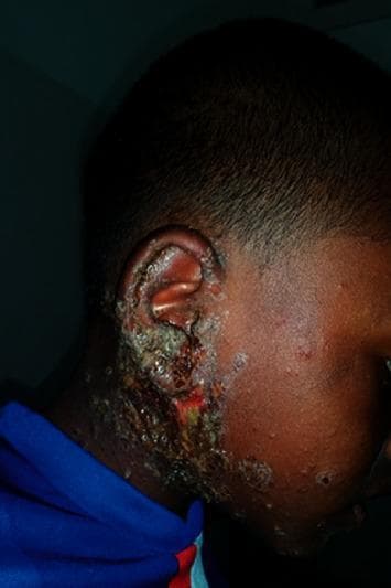 This clinical photograph displays a pediatric patient with classic signs of impetigo, a highly contagious bacterial skin infection commonly caused by Staphylococcus aureus or Streptococcus pyogenes. The visual focus is on the right auricular and preauricular regions, extending down toward the neck and onto the cheek. The primary lesions are characterized by thick, adherent, honey-colored (mellicerous) crusts overlying erythematous bases. Areas of active serosanguinous exudate and open erosions are visible, particularly around the earlobe and external auditory meatus. Surrounding the main confluent plaques, scattered satellite papules and small pustules are present on the facial skin, indicating local spread. The surrounding skin shows signs of inflammation and secondary irritation. This image serves as a hallmark educational example of non-bullous impetigo, emphasizing the distinctive crusting morphology and typical distribution in pediatric dermatology.
