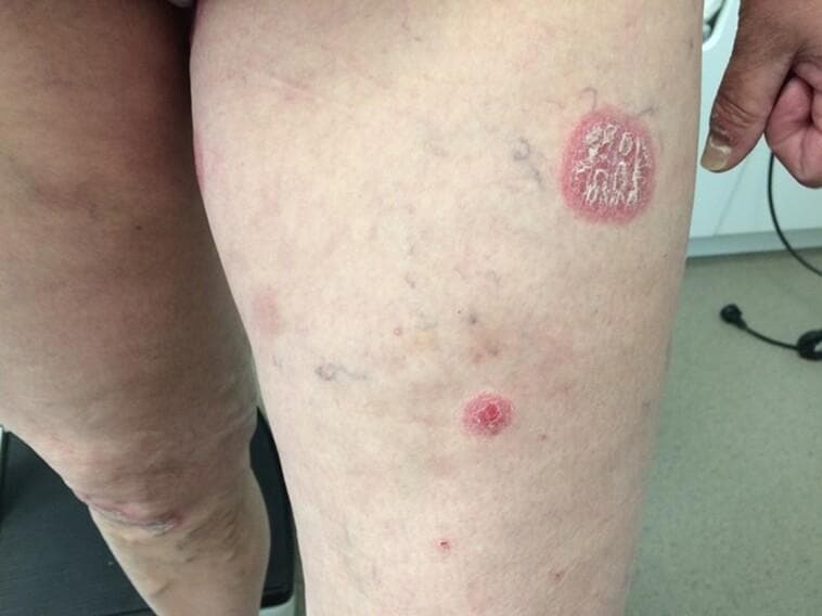 This clinical photograph displays a human anterior proximal thigh exhibiting classic psoriatic lesions as part of the Koebner phenomenon. The primary feature is a large, well-demarcated, circular-to-oval erythematous plaque. This lesion is characterized by a raised red border and a central surface covered in thick, silvery-white micaceous scales. Disseminated across the surrounding skin are smaller, satellite erythematous papules and plaques of varying diameters, some appearing as pinpoint lesions. The background skin shows signs of mild solar damage, visible superficial vasculature (telangiectasia), and minor blemishes. This visual presentation demonstrates an isomorphic response, where localized skin trauma—specifically insulin injection sites in this clinical context—triggers the development of psoriatic plaques in a patient with a history of psoriasis. This is typical of a disease flare-up following the withdrawal of systemic therapy like methotrexate. The image is a primary educational resource for dermatological morphology, illustrating plaque psoriasis and the Koebner phenomenon.