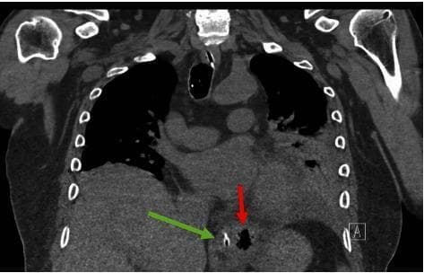 This non-contrasted coronal CT scan of the chest and upper abdomen demonstrates diagnostic features of Boerhaave's Syndrome (spontaneous esophageal perforation). A prominent red arrow points to an extraluminal pocket of gas (pneumomediastinum) located in the lower mediastinum, positioned left-lateral to the distal esophagus. Adjacent to this air collection, a green arrow identifies a nasogastric (NG) tube situated within the esophageal lumen, providing a landmark for the esophageal anatomy. The mediastinal air is seen near the diaphragmatic hiatus, a common site for pressure-induced rupture. The surrounding lung fields show partial opacification and are somewhat obscured by mediastinal structures, though no large pleural effusions are immediately apparent in this view. This imaging is critical for differentiating esophageal rupture from other causes of acute chest pain, such as aortic dissection or myocardial infarction, particularly when clinical history involves forceful vomiting or retching.
