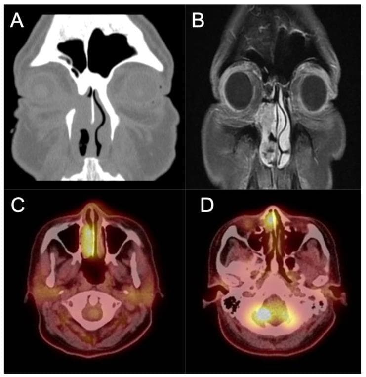 Multi-modal diagnostic imaging of inverted papilloma (IP) with malignant transformation into squamous cell carcinoma (SCC). (A) Coronal non-contrast CT scan shows a large, soft-tissue density mass occupying the right nasal cavity and ethmoid sinus. Visible bony dehiscence of the medial orbital wall (lamina papyracea) indicates aggressive local erosion. (B) Coronal T1-weighted contrast-enhanced MRI provides superior soft-tissue resolution, clearly delineating the tumor's invasion into the medial orbit and periorbita. (C, D) Axial PET/CT fusion images reveal intense FDG avidity (metabolic activity) localized to the right nasal mass, facilitating the differentiation between viable tumor and inspissated secretions. These images collectively illustrate the radiographic features of locally advanced sinonasal malignancy, emphasizing the importance of correlating CT (for bone assessment), MRI (for orbital/dural invasion), and PET/CT (for metabolic staging) in surgical planning and management of secondary malignant degeneration in chronic sinonasal disease.