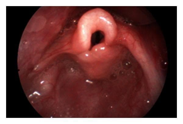 This clinical photograph displays a flexible laryngoscopic view of the infant larynx, demonstrating classic diagnostic features of laryngomalacia. The primary pathological finding is an omega-shaped or tubular epiglottis, which appears tightly curled and rolled upon itself. Surrounding the laryngeal inlet, the aryepiglottic folds are notably shortened, contributing to the constriction of the airway space. Additionally, there is prominent, redundant mucosa over the arytenoid cartilages, appearing as thickened, pinkish-red tissue that can collapse into the glottis during inspiration. The surrounding pharyngeal mucosa is moist and shows no signs of acute inflammation or ulceration. This image serves as a definitive educational example of the structural abnormalities causing congenital inspiratory stridor in pediatric patients. The clinical significance lies in the dynamic obstruction created by these floppy supraglottic structures, which typically manifests as stridor during the first weeks of life.