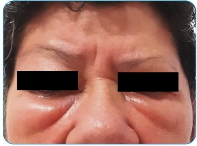 Clinical photograph of a 63-year-old female's mid and upper face, demonstrating significant bilateral periocular angioedema. The primary pathology is localized in the infraorbital and periorbital regions, presenting as pronounced soft-tissue swelling (edema) of the lower eyelids and malar areas. The affected skin appears taut, shiny, and erythematous, with visible skin wrinkling beneath the eyes indicative of acute fluid accumulation and tissue distension. The forehead and glabella regions exhibit horizontal and vertical rhytides (wrinkles), which appear accentuated by the surrounding facial edema. The eyes are partially obscured by black bars for patient privacy, yet the surrounding inflammatory reaction is clearly visible. This image serves as a clinical example of a localized Type I hypersensitivity-like reaction, specifically angioedema, involving the subcutaneous tissues and conjunctiva. Key educational concepts include the recognition of facial angioedema, distinguishing it from periorbital cellulitis, and understanding it as a potential, though rare, adverse reaction following immunization.