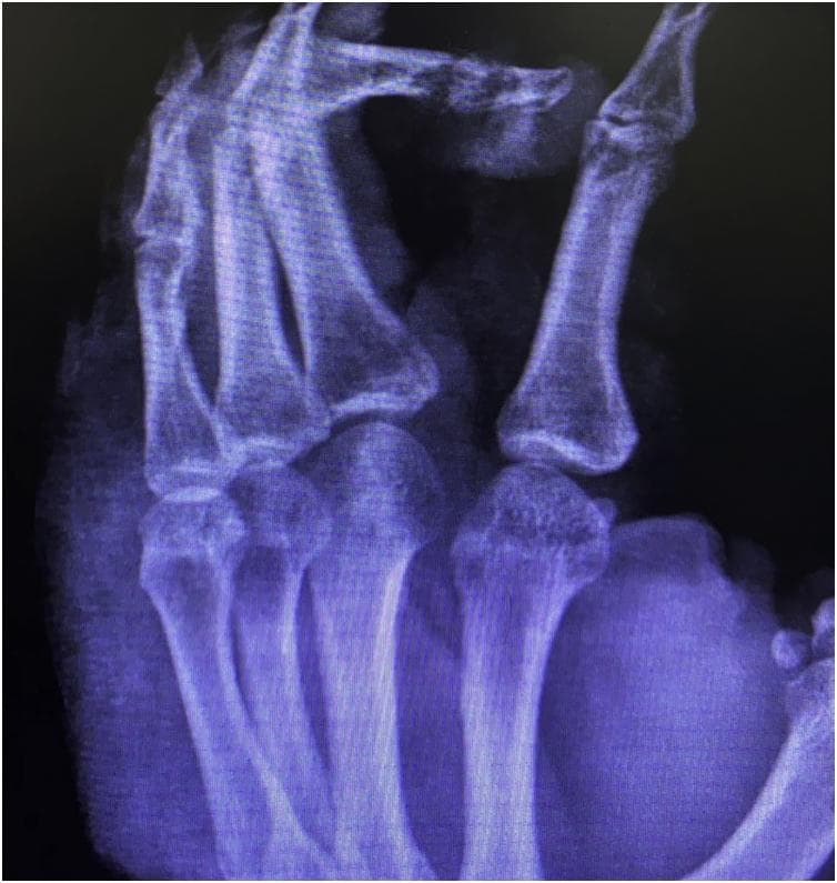 This diagnostic X-ray of the right hand demonstrates significant pathology localized to the third digit, consistent with chronic osteomyelitis. The imaging reveals extensive destruction of the cortical bone involving both the middle and distal phalanges. A hallmark finding of chronic infection, bone sequestration (sequestrum), is visible, characterized by fragments of necrotic, radiodense bone that have separated from the living bone tissue. The third finger shows marked anatomical deformity and soft tissue swelling. In contrast, the remaining phalanges, metacarpals, and visualized carpal bones maintain relatively normal bone density, cortical integrity, and joint alignment. This image serves as a clinical example of skeletal complications resulting from long-standing infections, such as those complicating cutaneous leishmaniasis with secondary bacterial superinfection. The primary educational focus is the radiological identification of cortical erosion and sequestrum formation in the context of chronic osteomyelitis.