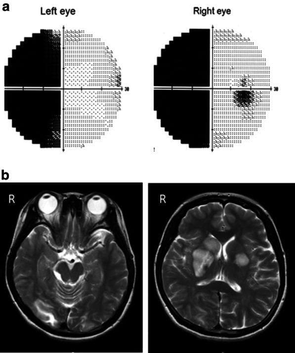 This composite educational image displays a correlation between clinical neuro-ophthalmology findings and neuroimaging. Section (a) shows Automated Static Perimetry (visual field tests) for the left and right eyes, exhibiting a dense left homonymous hemianopsia, characterized by total vision loss in the left temporal field of the left eye and left nasal field of the right eye. Section (b) provides two axial brain MRI slices using T1-weighted fluid-attenuated inversion recovery (T1-FLAIR) sequences. The images demonstrate areas of hyperintense signal indicating edema and infarction within the right basal ganglia (caudate and putamen) and the right occipital lobe. The occipital lesion specifically correlates with the functional visual field defect observed in section (a). This visual material is used to demonstrate the localization of intracranial pathology along the visual pathway, specifically post-chiasmatic lesions in the right hemisphere resulting in contralateral visual field deficits. It is relevant for medical training in neurology, ophthalmology, and radiology.